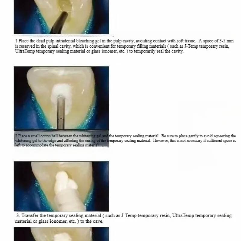 치과 구강 복원 재료, 죽은 뉴트리아, 치아 미백제,  - Teeth Whitening Effects 리뷰 및 가격