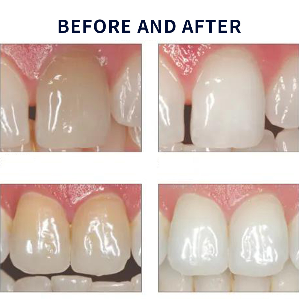 유백광 미백 20% PF 20 16 젤 키트, 초강력  - Teeth Whitening With Hydrogen Peroxide 리뷰 및 가격