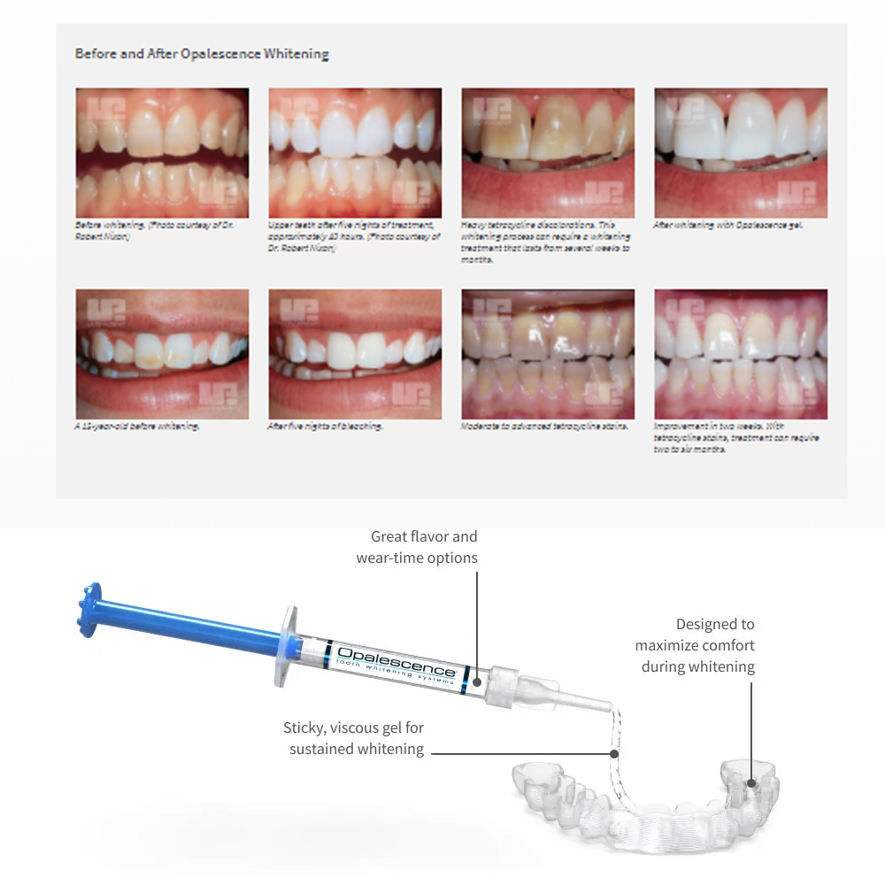 유백광 미백 20% PF 20 16 젤 키트, 초강력  - Teeth Whitening With Hydrogen Peroxide 리뷰 및 가격