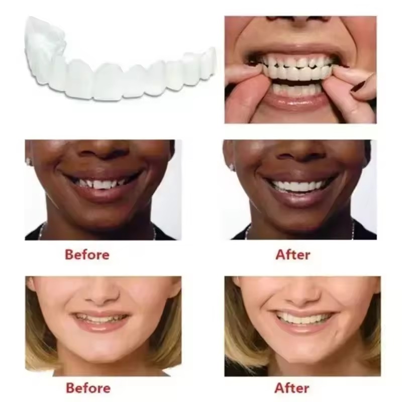 치아 베니어 화이트닝 틀니 교정기 임시 가짜 치아 커버 - Teeth Whitening Session 리뷰 및 가격