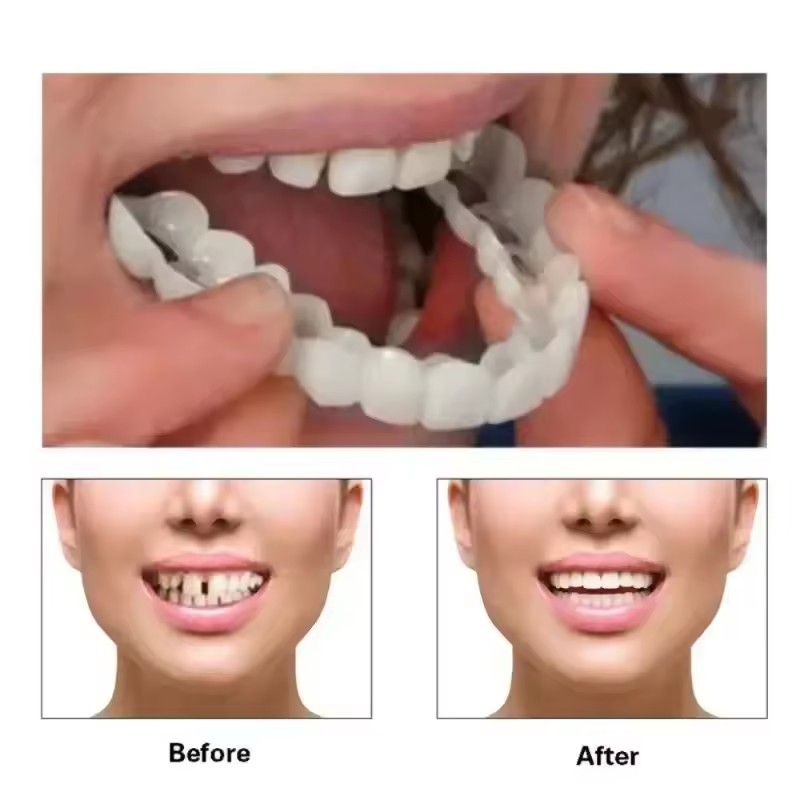 치아 베니어 화이트닝 틀니 교정기 임시 가짜 치아 커버 - Teeth Whitening Session 리뷰 및 가격