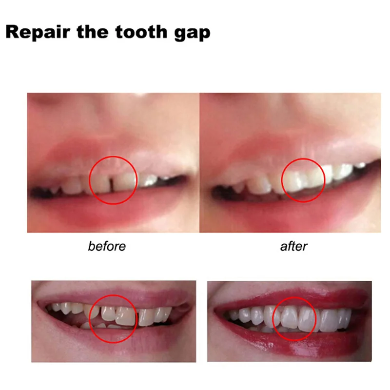 치아 수리 접착제 모양 가능한 임시 간격 누락 깨진 충 - Teeth Whitening At Home 리뷰 및 가격