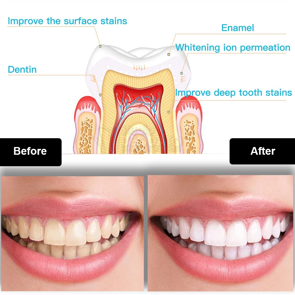 치과 치아 미백 키트 미니 16 LED 콜드 라이트 3 - Teeth Whitening At Home 리뷰 및 가격