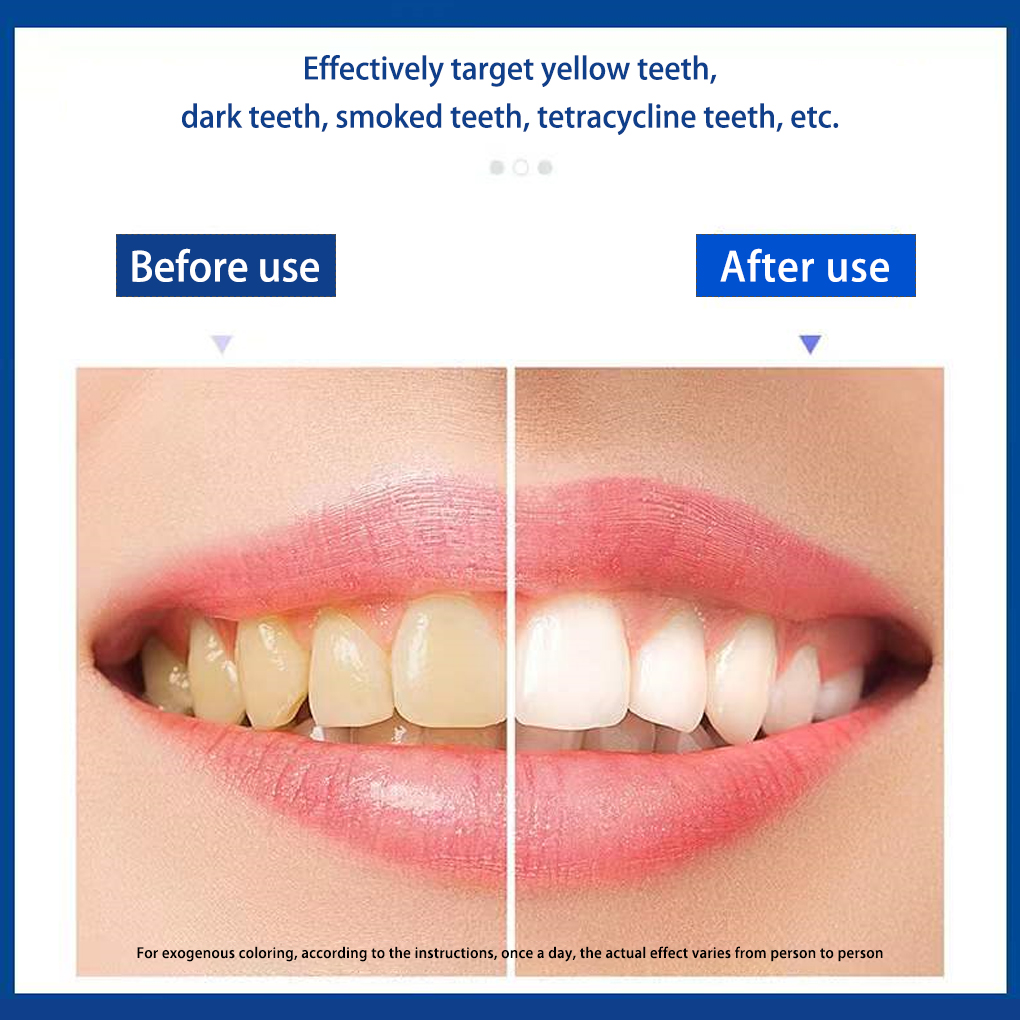 70/140 쌍 5D 흰색 치아 미백 스트립 전문 효과 - Teeth Whitening Effects 리뷰 및 가격